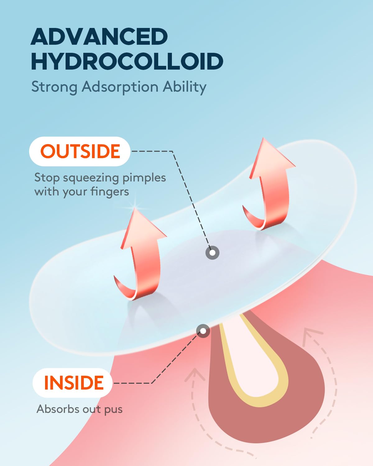 ZATKTK Acne Pimple Patch (180 Counts 4 Sizes), Invisible Hydrocolloid Acne Patch with Tea Tree Oil & Calendula Oil, Acne Spot Patch Zit Patches for Face