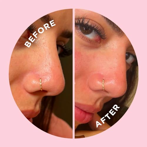 ZitSticka Pimple Patches for Face and Body, Hydrocolloid Patches to Cover Zits & Blemishes, Acne Patches or Zit Spot Stickers, Body Blemish Patch (GOO GETTER BODY PATCH 9 Pack)