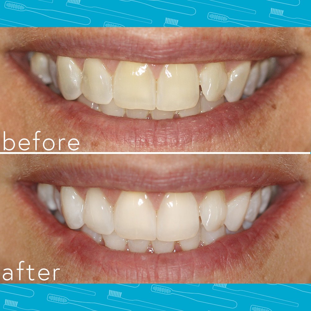 Smileactives Advanced Teeth Whitening Pen- with Tooth Whitening Gel for White Teeth, Vanilla Mint Duo Pack + Winterberry Duo Pack - Travel Size 0.11 Ounce Each