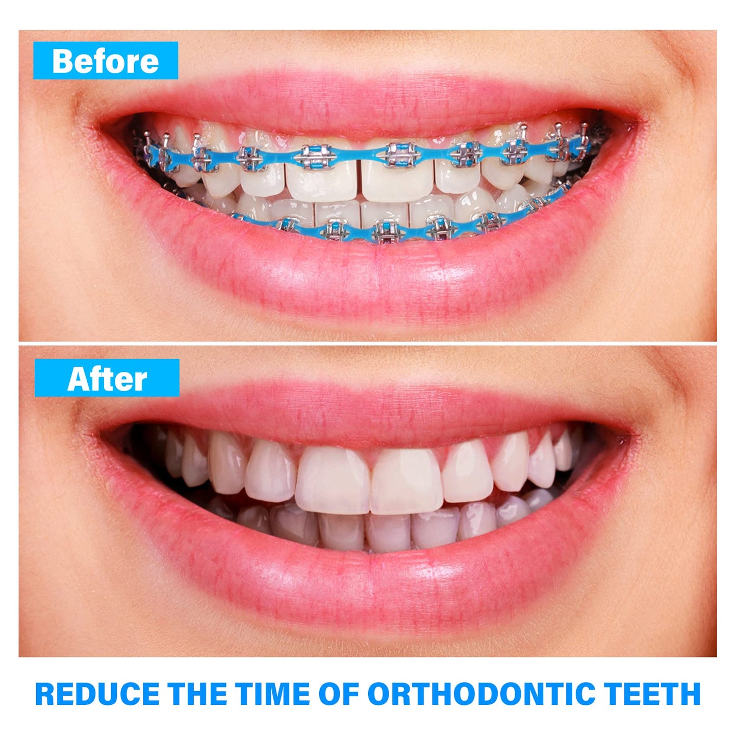 Annhua Dental Orthodontic Elastic Chain, Dental Spool Elastic Rubber Band Power Chains for Braces - Long, Blue - 1# - 15ft/Roll, Used for Orthodontic Braces