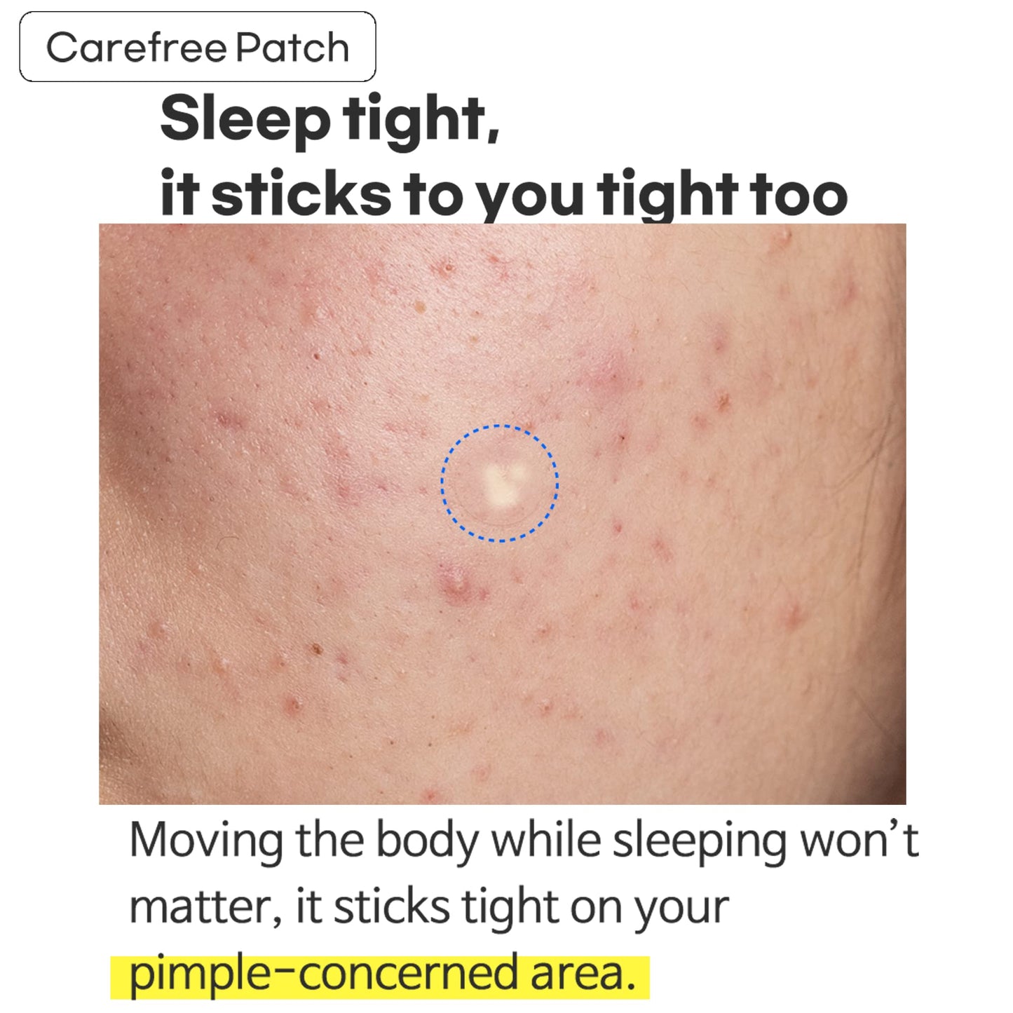 TIAM Surprise B Patch (24 Count, Pack of 1), Hydrocolloid Acne Patches for Acne Treatment, Pimple Patch for Face, Acne Pimple Patch