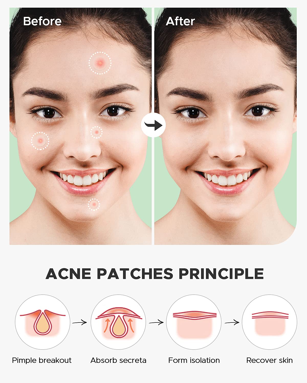 ZATKTK Acne Pimple Patch (180 Counts 4 Sizes), Invisible Hydrocolloid Acne Patch with Tea Tree Oil & Calendula Oil, Acne Spot Patch Zit Patches for Face