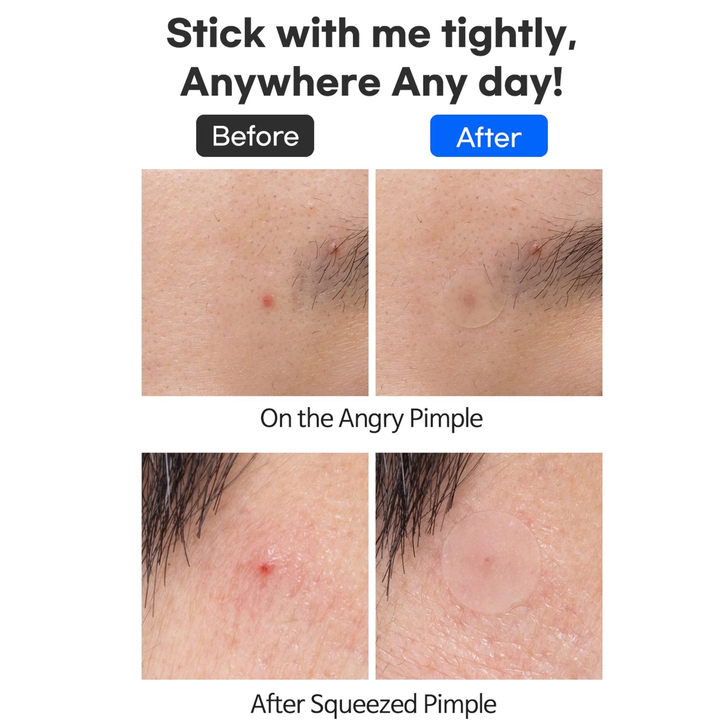 TIAM Surprise B Patch (24 Count, Pack of 1), Hydrocolloid Acne Patches for Acne Treatment, Pimple Patch for Face, Acne Pimple Patch