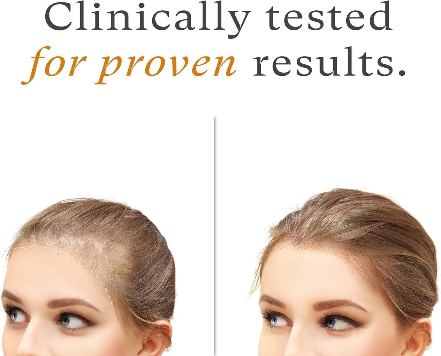 OBOGEE Women's Balance Hair Growth Supplements Proven Hair Supplement for Visibly Thicker Hair and Scalp Coverage, Dermatologist (1 PACK) (Pack, 240, Count)