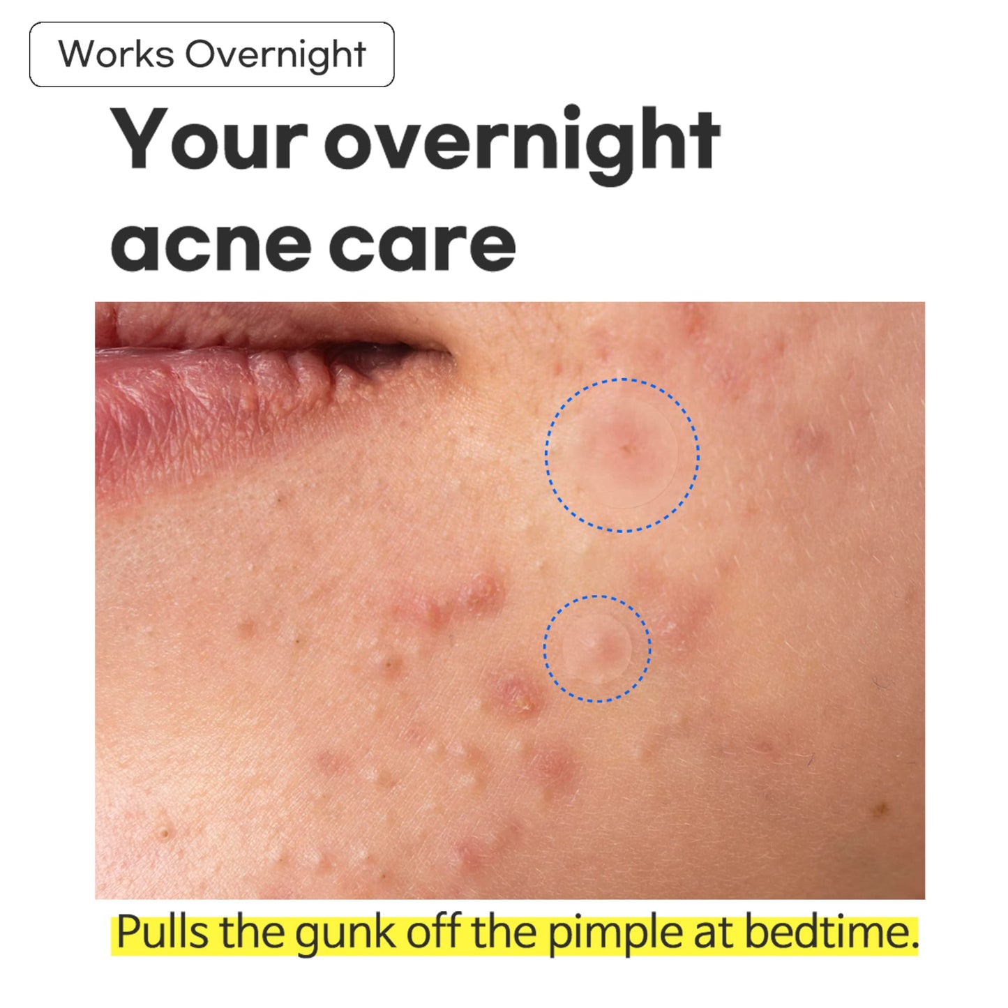 TIAM Surprise B Patch (24 Count, Pack of 1), Hydrocolloid Acne Patches for Acne Treatment, Pimple Patch for Face, Acne Pimple Patch